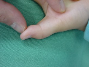 強直母指の写真